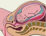Odtrhnutie placenty v neskorom tehotenstve: príčiny a dôsledky