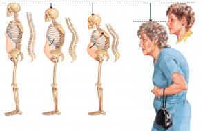 Therapeutic exercise for the elderly