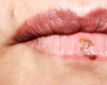 Peeling des lèvres - comment choisir les options de traitement ?