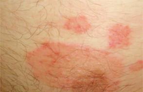 चिकनी त्वचा का माइकोसिस आईसीडी।  फंगल रोग.  बच्चों में चिकनी त्वचा का माइकोसिस
