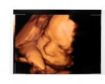 Dzemdes ultraskaņa grūtniecības laikā: kāda informācija tiek iegūta ar tās palīdzību
