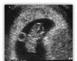 Akušerinės ir embrioninės nėštumo stadijos