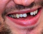 Ovechkin a fost lovit în față de un puc și aproape că a pierdut al doilea dinte Jucători de hochei fără dinți