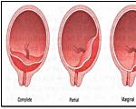 Ką daryti su placentos (choriono) previa: kraštinė, centrinė, žema, pilna?