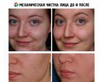 Mehaničko čišćenje lica: detaljne upute za postupak